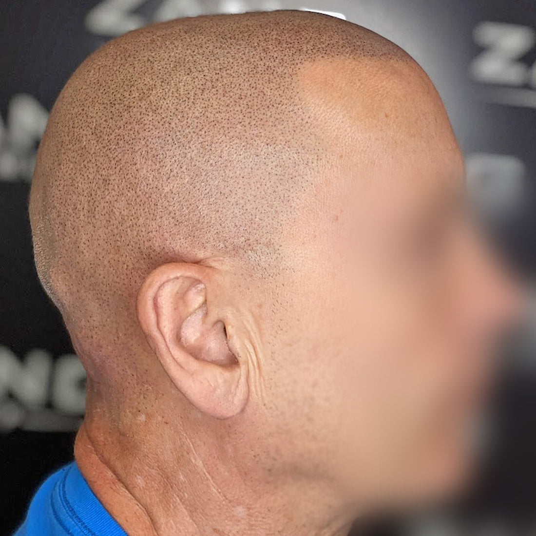 Man who suffered from Androgenetic Alopecia getting scalp micropigmentation done by Zang SMP.