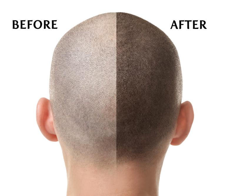 The Safety and Efficacy of Scalp Micropigmentation Explored