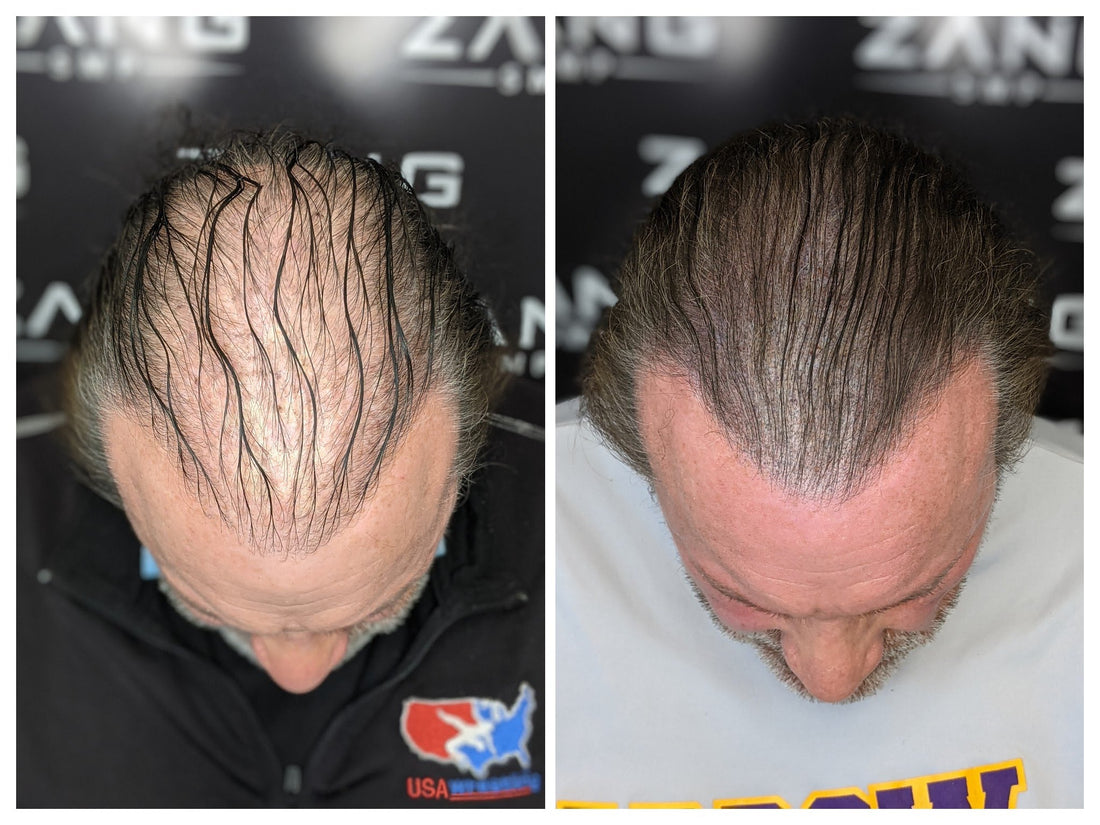 Man received density procedure to solve his hair loss with Scalp Micropigmentation. 