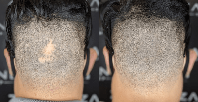 Addressing Common Concerns About Scalp Micropigmentation Safety