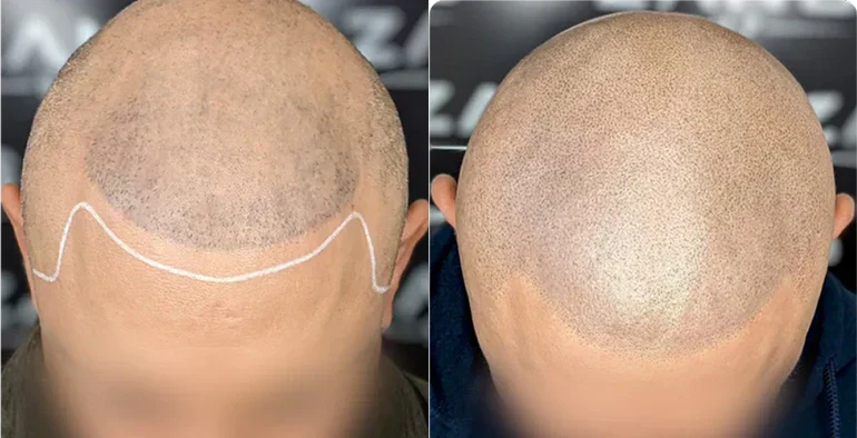 Best Treatment for Thinning Hair in Men: Why Scalp Micropigmentation Works