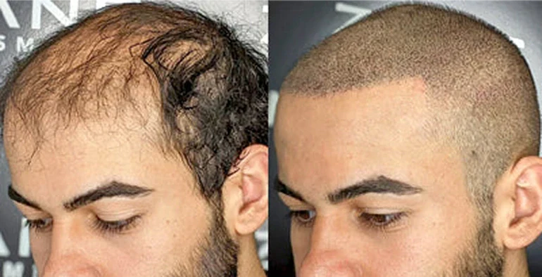 Can SMP Make Thin Hair Look Full? Real Results Explained
