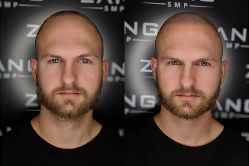 Comparing Scalp Micropigmentation (SMP) with Other Hair Loss Treatments