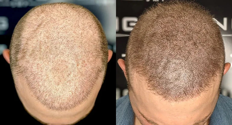 Correcting Botched SMP: Effective Repair Strategies Without Laser Removal