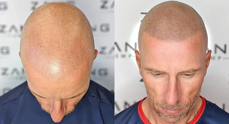 Does Scalp Micropigmentation Damage Hair Follicles? Myths vs. Facts