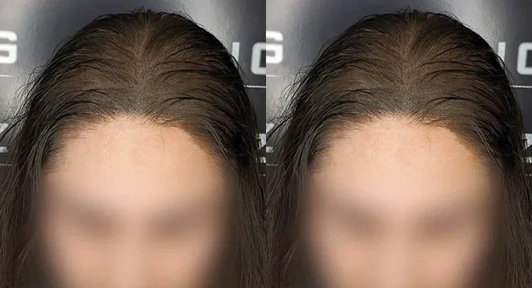 How to Fix Thinning Hair Without Surgery
