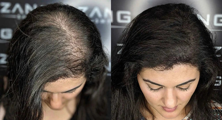 Scalp Micropigmentation for Women How SMP Works & What to Expect