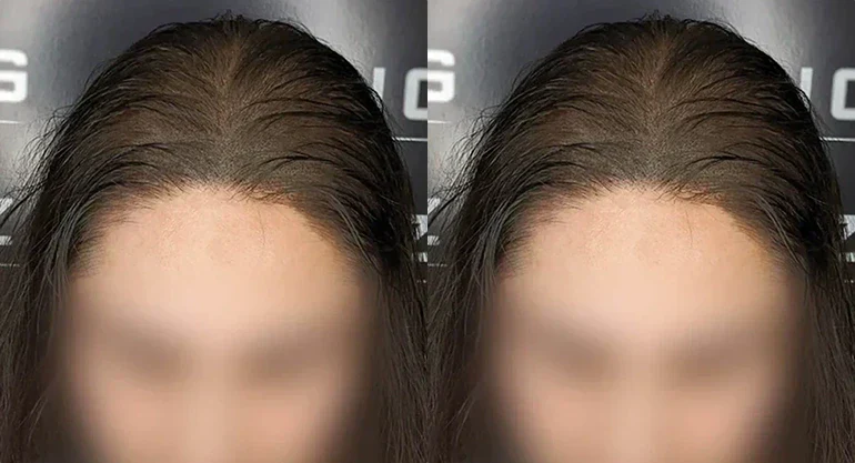 How to Fix Thinning Hair Without Surgery