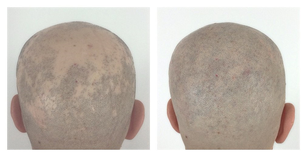 Scalp Micropigmentation: A Revolutionary Approach for Alopecia