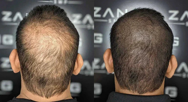 Hair Tattoo or Hair Transplant? How to Choose Based on Your Hair Loss Stage