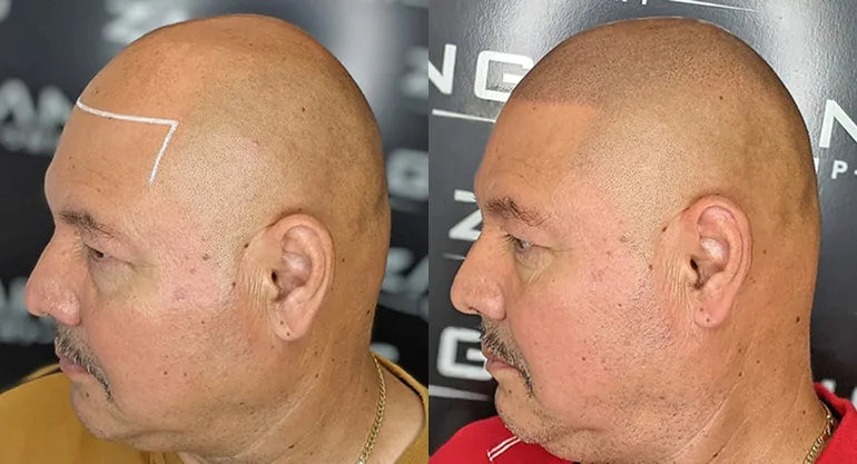 How Many Scalp Micropigmentation Sessions Do You Need for Best Results?