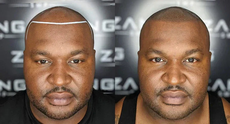 How Many Scalp Micropigmentation Sessions Do You Really Need?