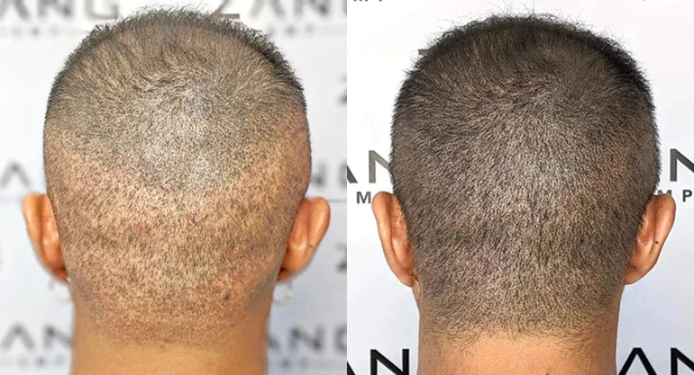 Is Scalp Micropigmentation Permanent? Understanding SMP Longevity & Maintenance