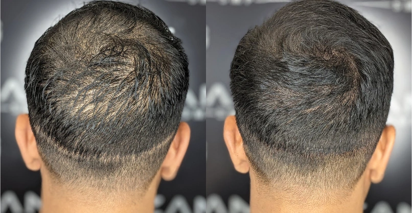 Long-Term Maintenance of Scalp Micropigmentation