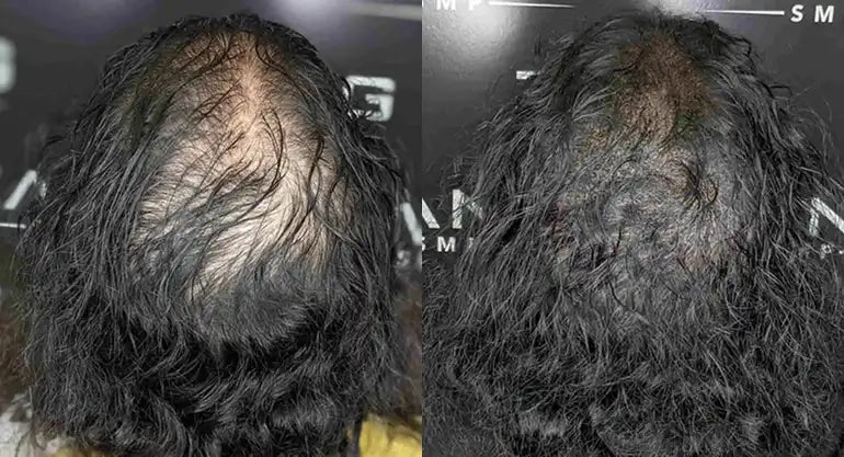 SMP Fading Explained How Scalp Micropigmentation Fades and When to Get a Touch-Up