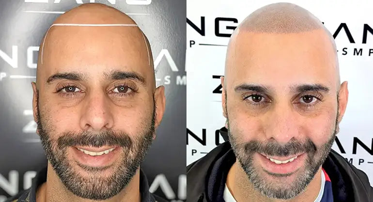 SMP and Self-Image: How Scalp Micropigmentation Boosts Confidence Beyond Appearance