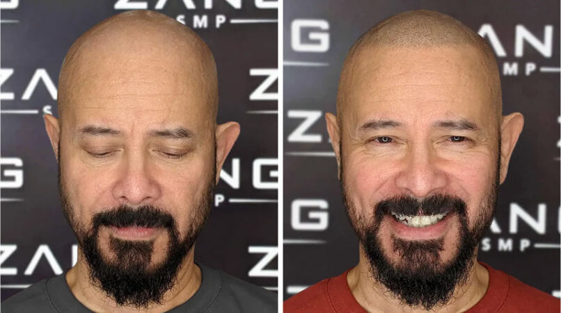 Scalp Micropigmentation A Permanent Solution to Hair Loss