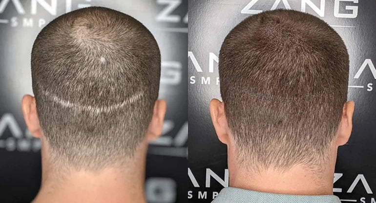 Scalp Micropigmentation vs. Hair Plugs: Key Differences and Results Compared