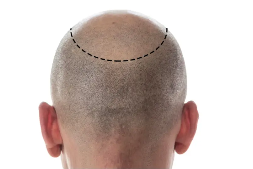 The Benefits of SMP for Hair Loss Solutions