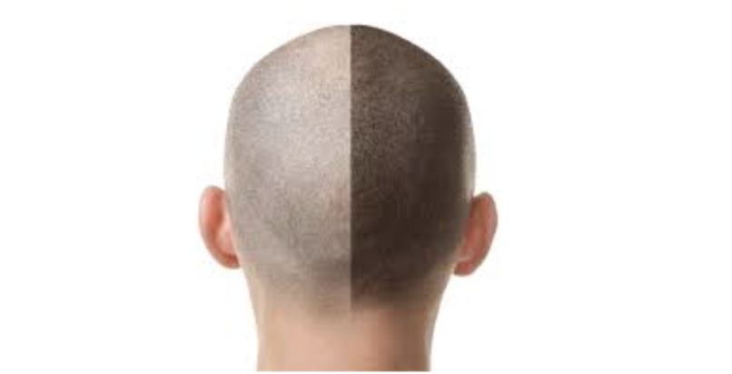 The Process of Scalp Micropigmentation: What To Expect