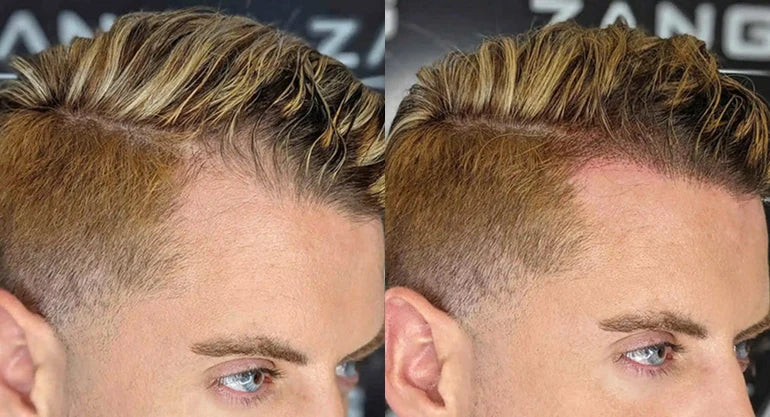 Top 5 Reasons to Choose Scalp Micropigmentation Over a Hair Transplant in Orange County