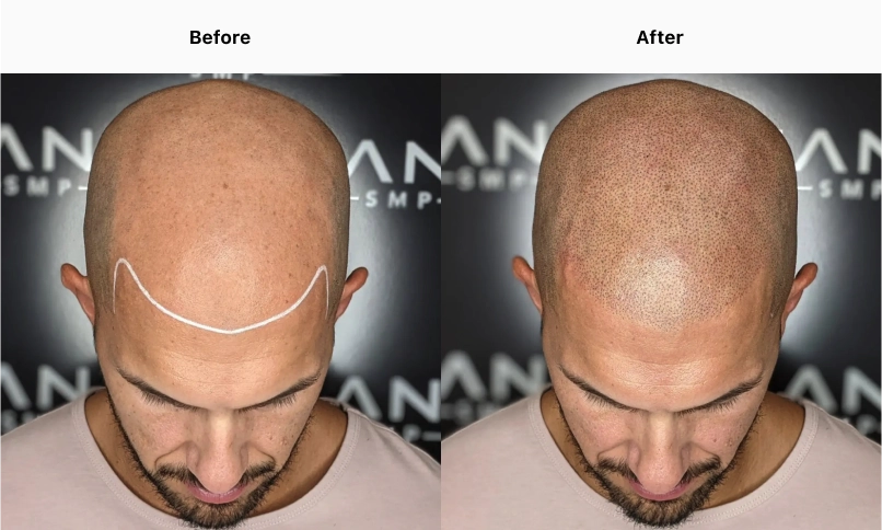 10 Incredible Before and After Transformations with Scalp Micropigmentation