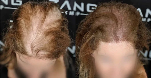 Treatment Options for Managing Female Pattern Baldness
