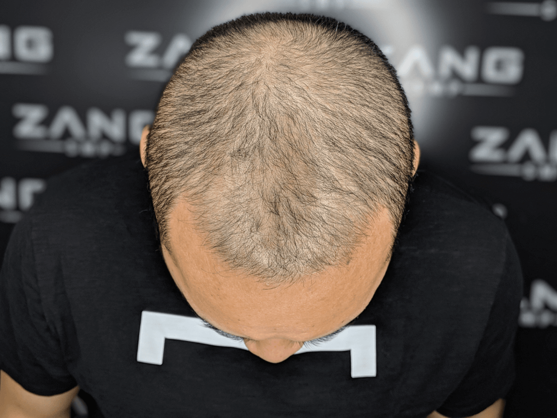 Understanding Hair Thinning Treatment: Why Scalp Micropigmentation is a Leading Solution