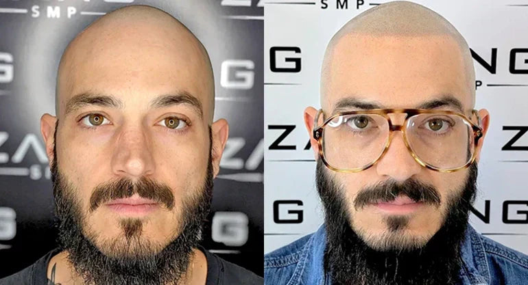 What to Expect During Your Scalp Micropigmentation Sessions: A Complete Timeline