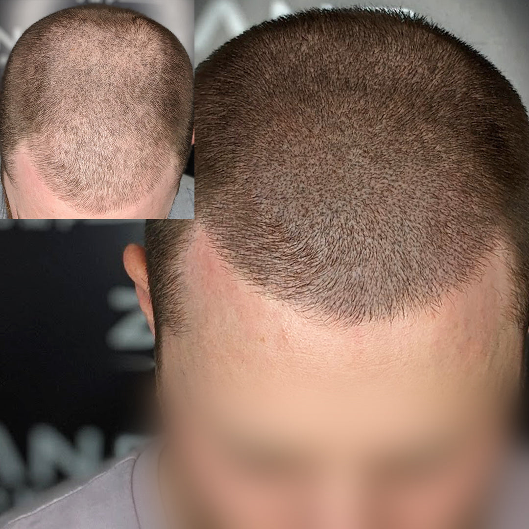 Client at Zang SMP getting hair appearance back with Scalp Micropigmentation