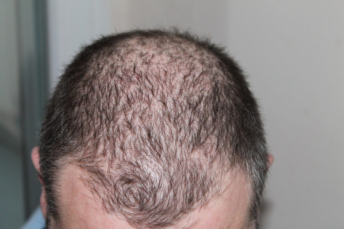 Busting Four Common Myths About Hair Loss