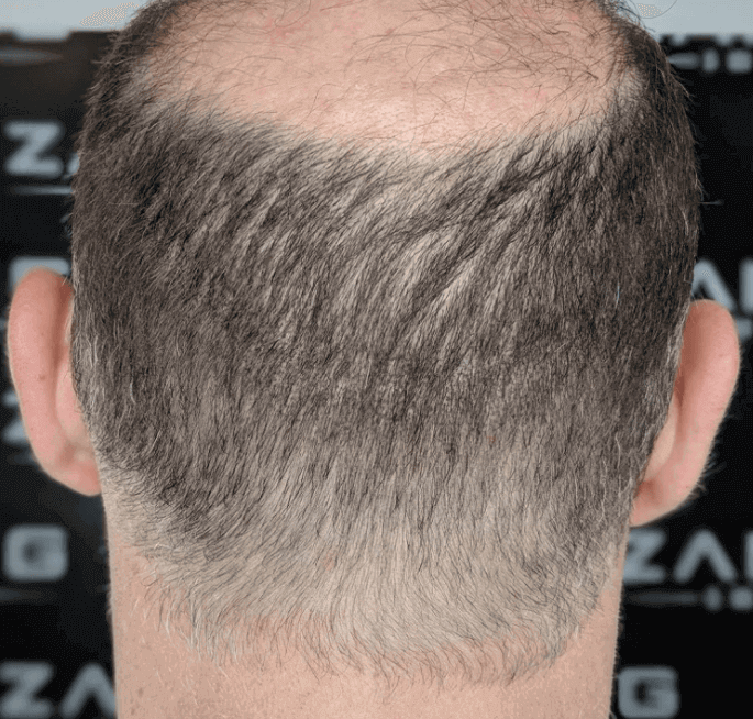 Hiding Hair Transplant Scars with Scalp Micropigmentation