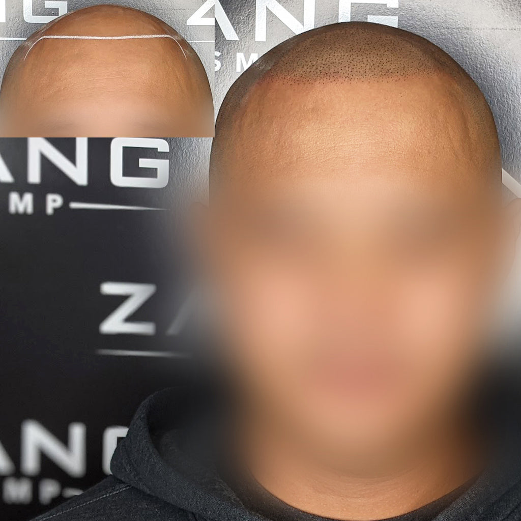 Scalp Micropigmentation for Men: A Guide - Zang SMP