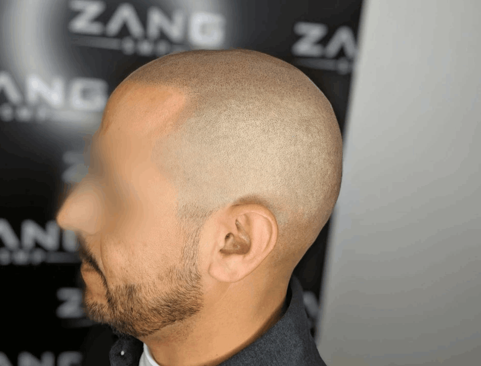 Essential Insights Before Starting Scalp Micropigmentation