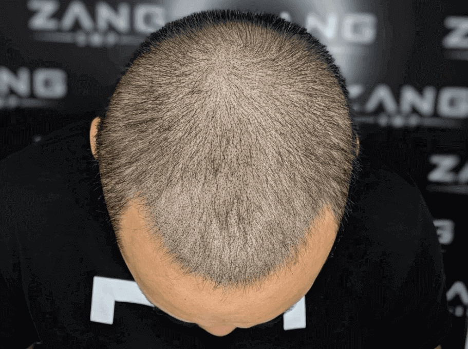 Natural Ways to Prevent Baldness and Keep Hair Healthy