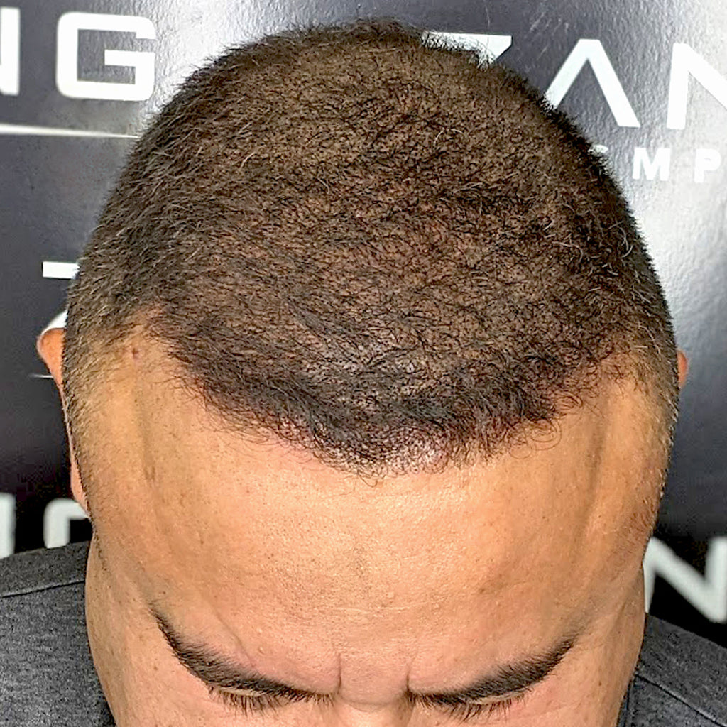 Hair Transplant Cost Alternative: Scalp Micropigmentation - Zang SMP