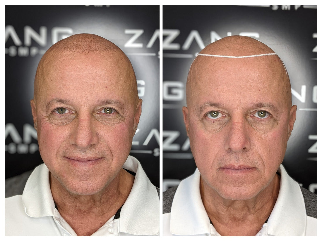 Client at Zang SMP receiving scalp micropigmentation - hair restoration service 