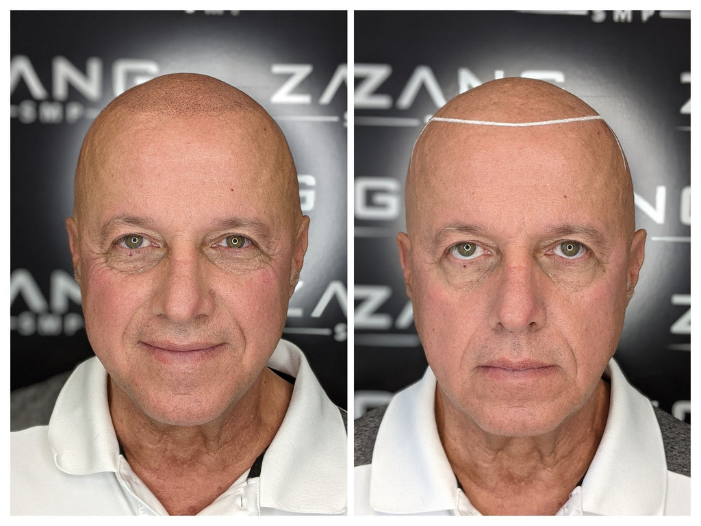 Scalp Micropigmentation: Hair Restoration Solution - Zang SMP