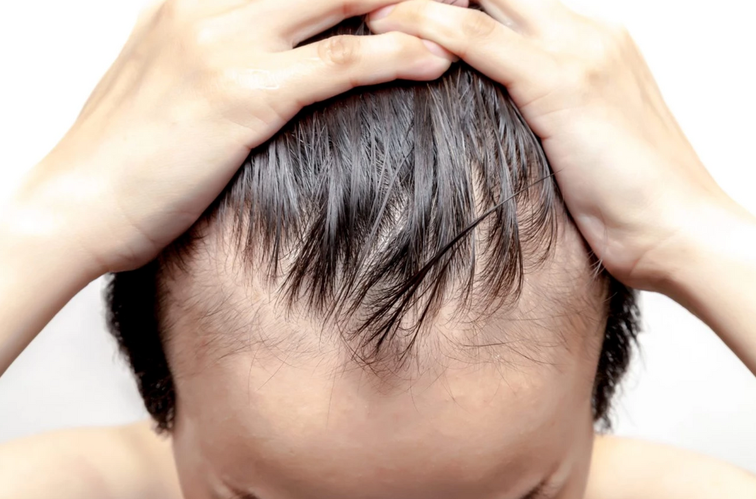 Choosing Between HIMS and Keeps for Hair Loss Treatment