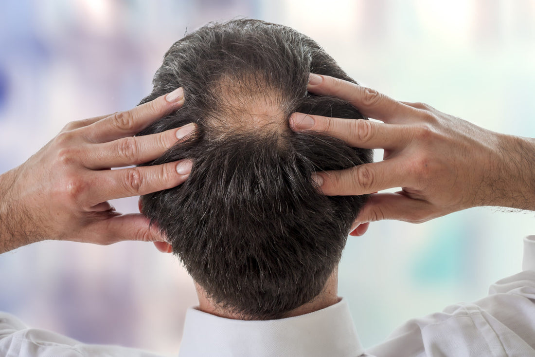 Essential Insights into Male Pattern Baldness