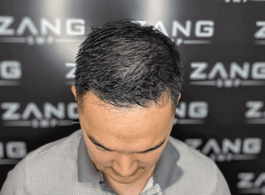 Early Warning Signs of Male Pattern Baldness and How to Act