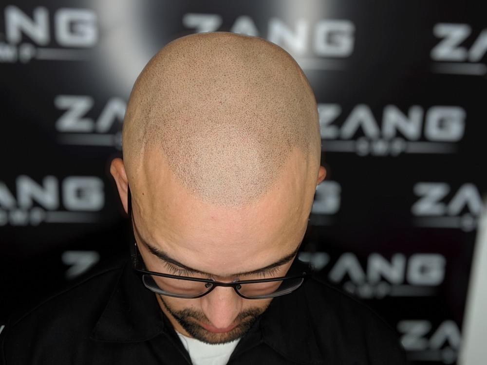 Navigating the Side Effects of Scalp Micropigmentation