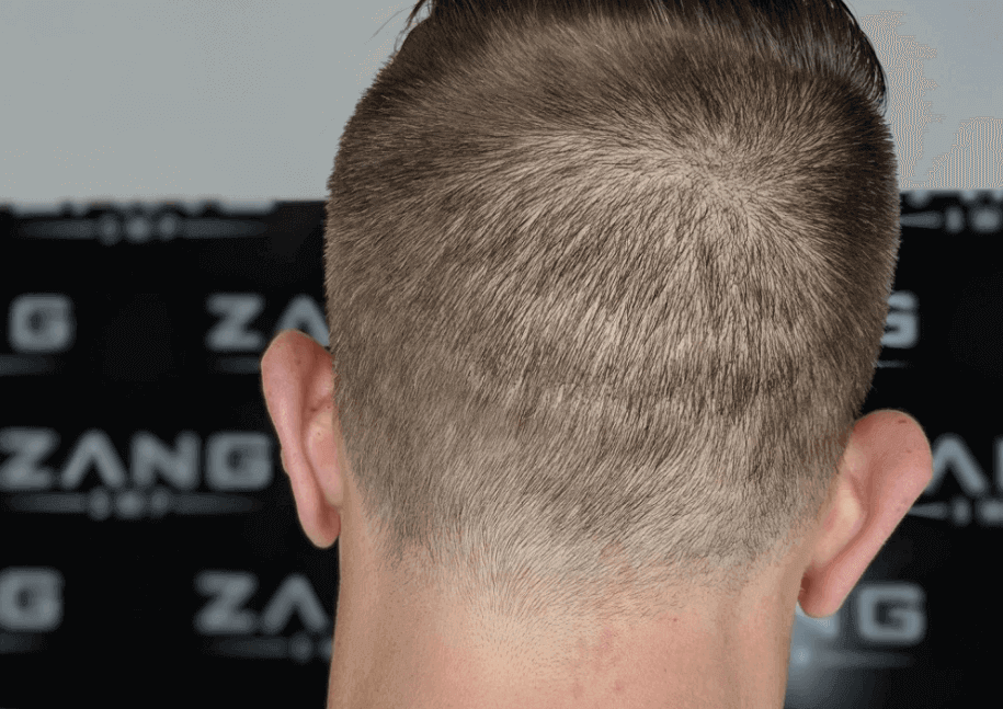 Varieties of Scalp Micropigmentation: Which One Is for You?