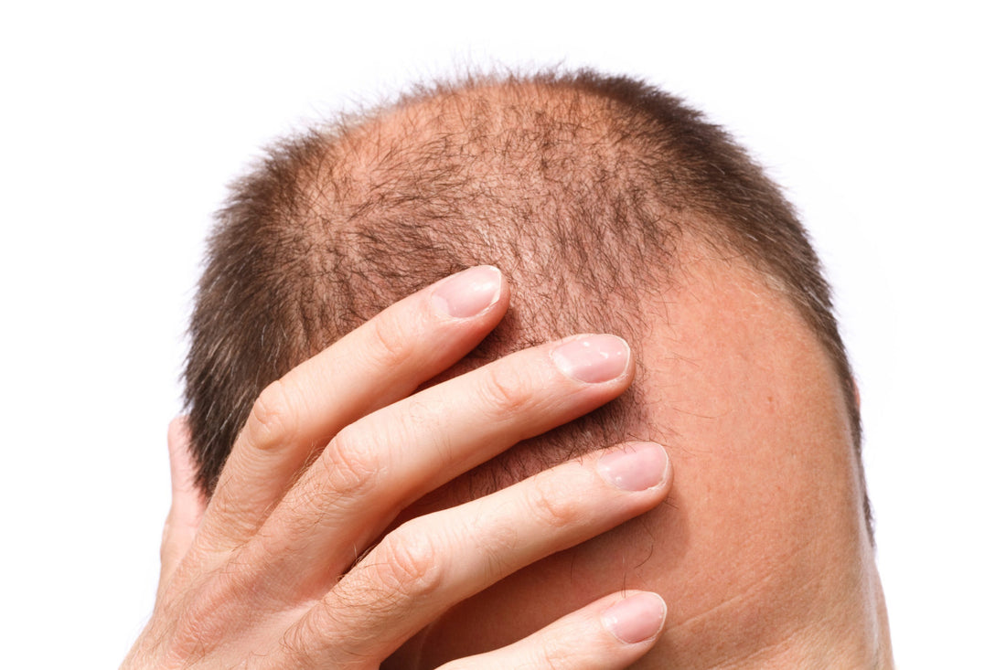 Understanding Why Men Experience Baldness More Frequently