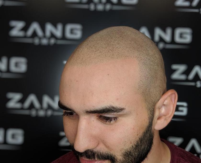 Caring for Your Scalp After SMP: A Comprehensive Guide