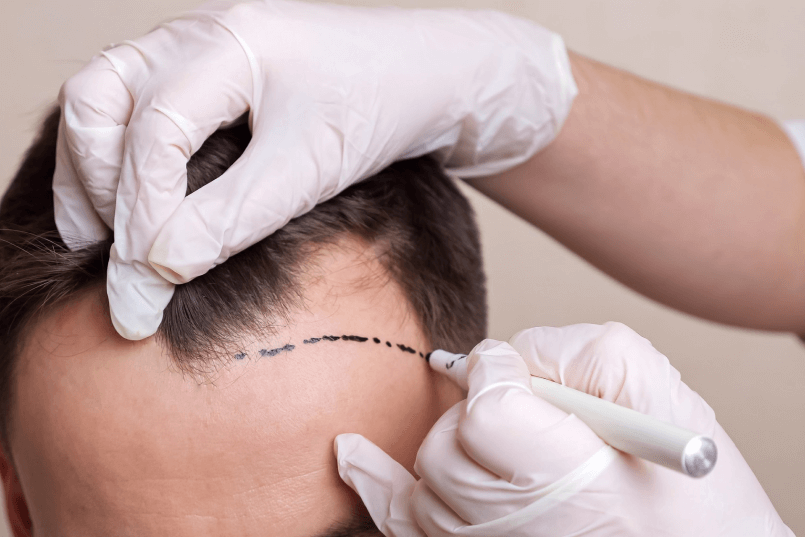 How Long Does Scalp Micropigmentation Last?