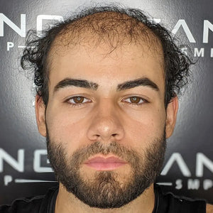 Young Man Aggressive Baldness Case Study