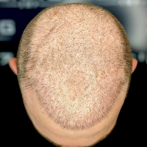 Density Filler for Thin Hair Case Study