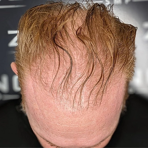 Density Filler for Thin Hair