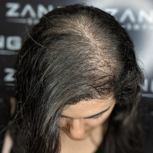 Female Pattern Hair Loss Case Study